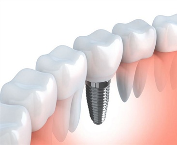 Созданы зубные импланты, способные сами врастать в кость