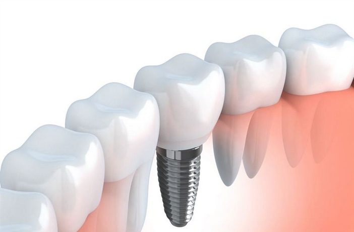 Созданы зубные импланты, способные сами врастать в кость